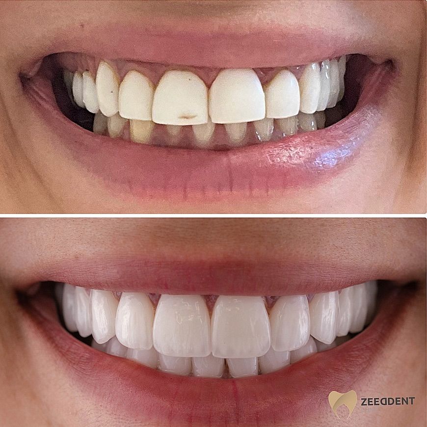 Veneers before and after