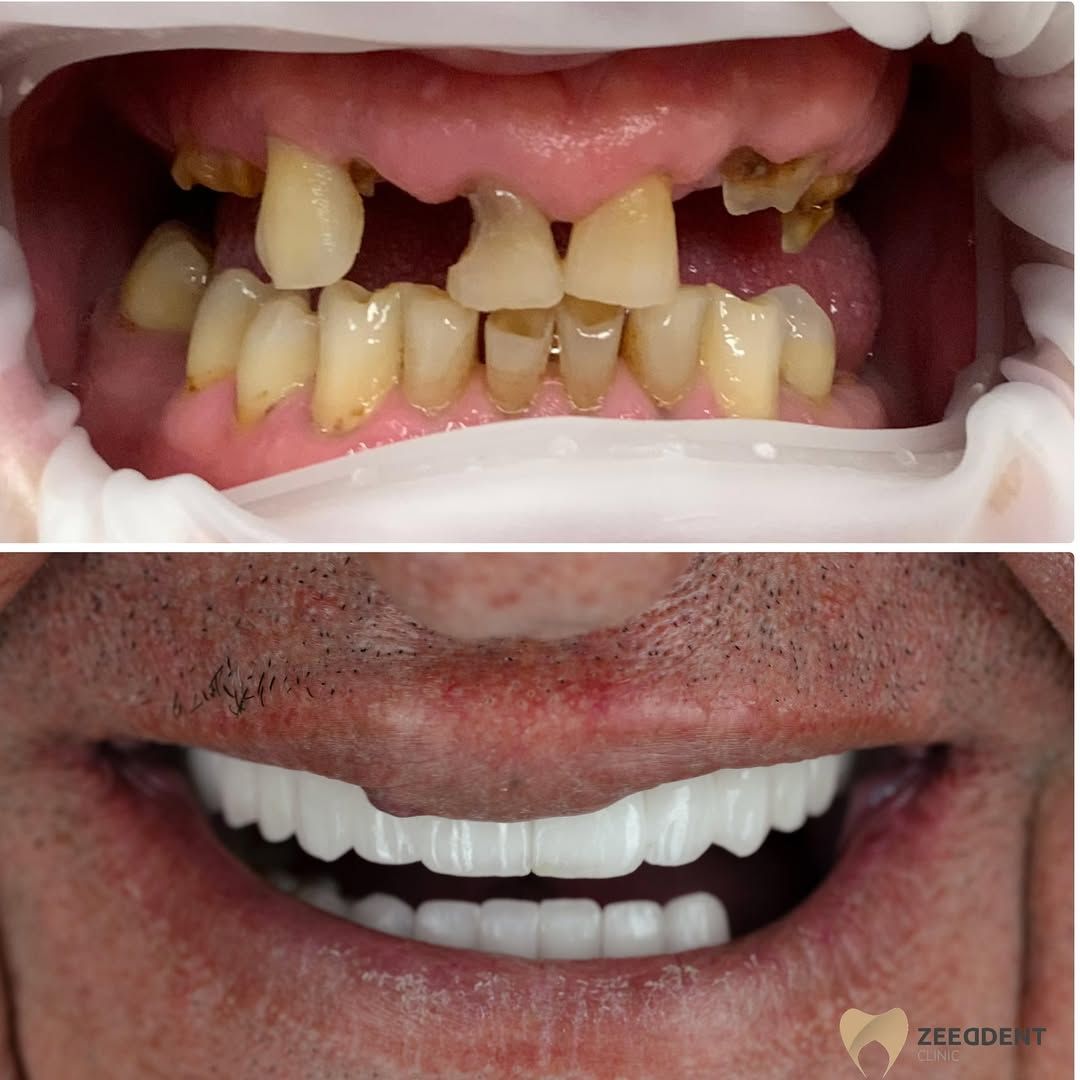 Dental implants before and after