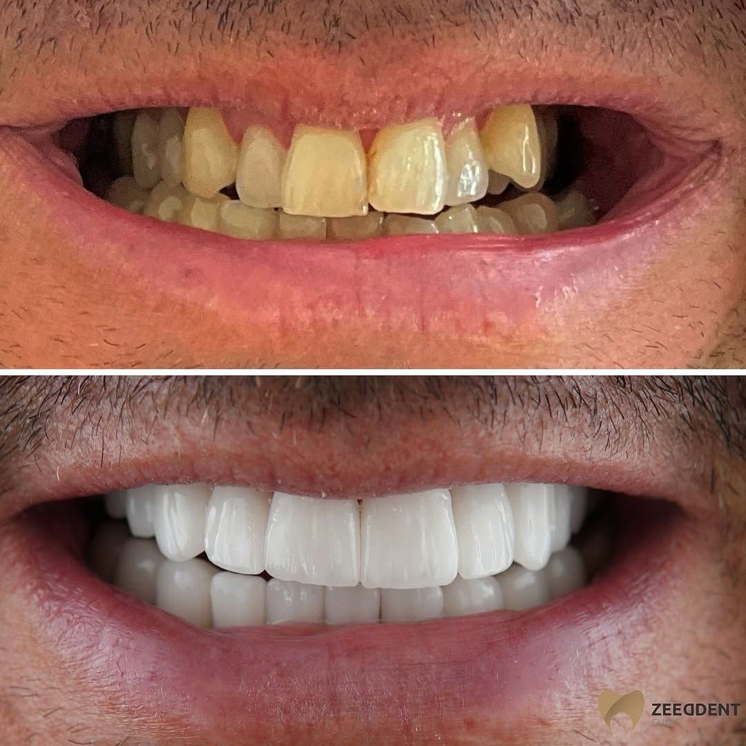 Veneers before and after