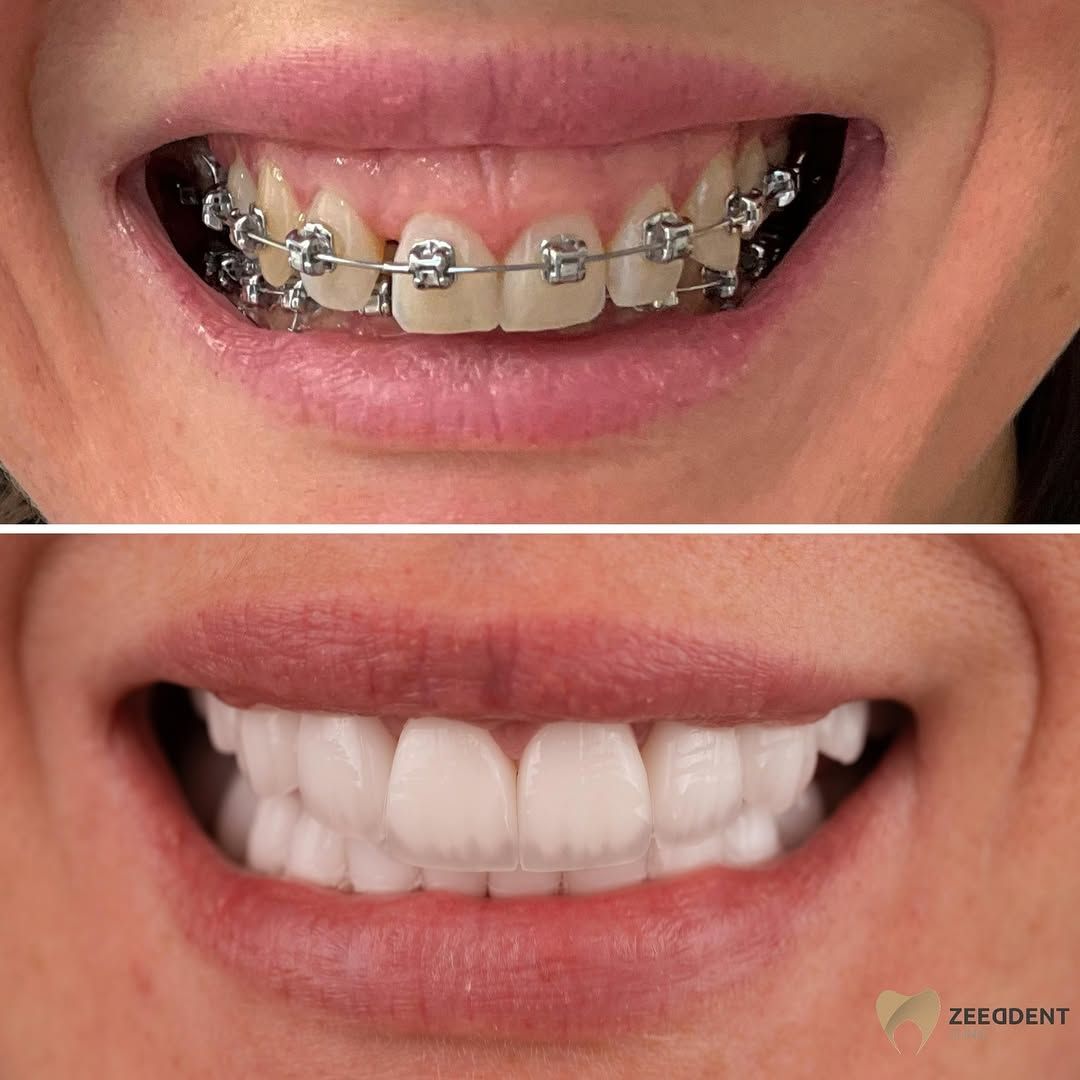 Veneers before and after