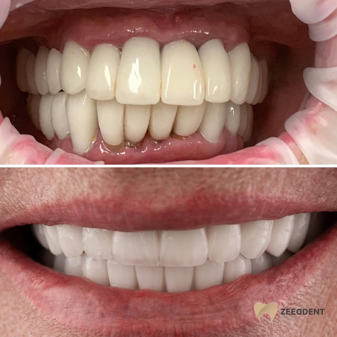 Dental implants before and after