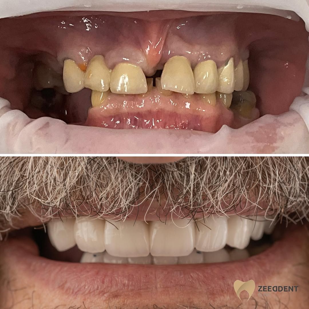 Dental implants before and after