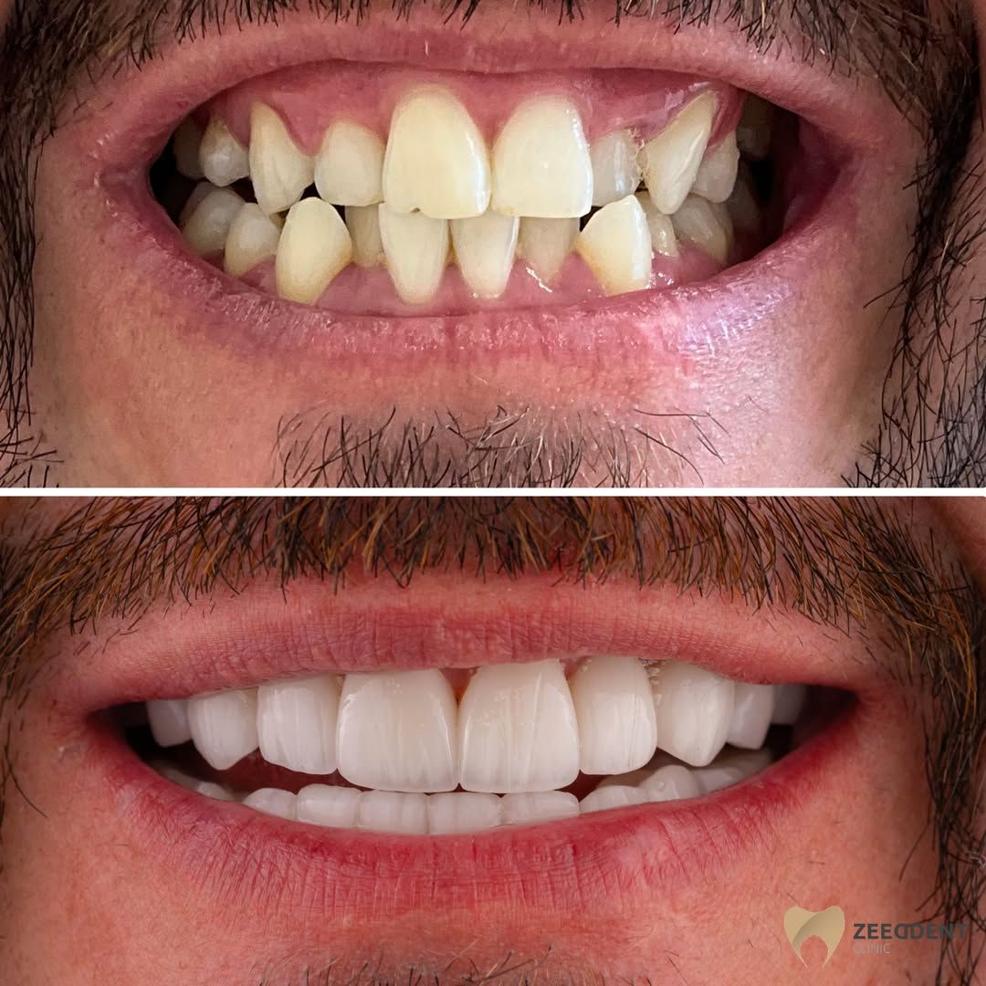 Veneers before and after